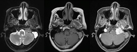 Fig 2. MRI (T2W, T1W, T1W post-contrast)